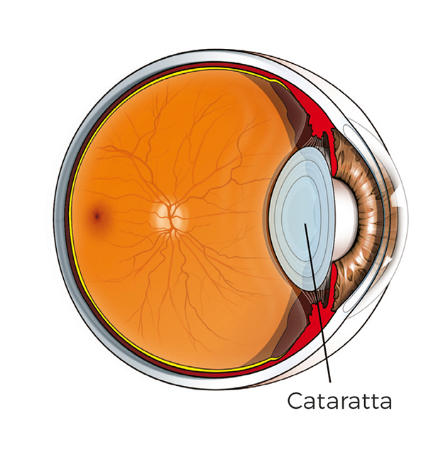 Cataratta