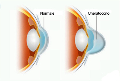 Cheratocono