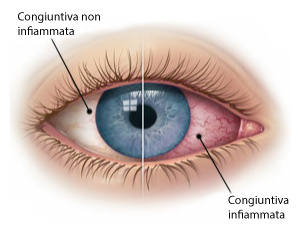 Congiuntivite