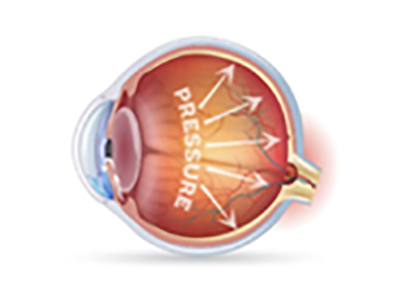 Occhio con glaucoma